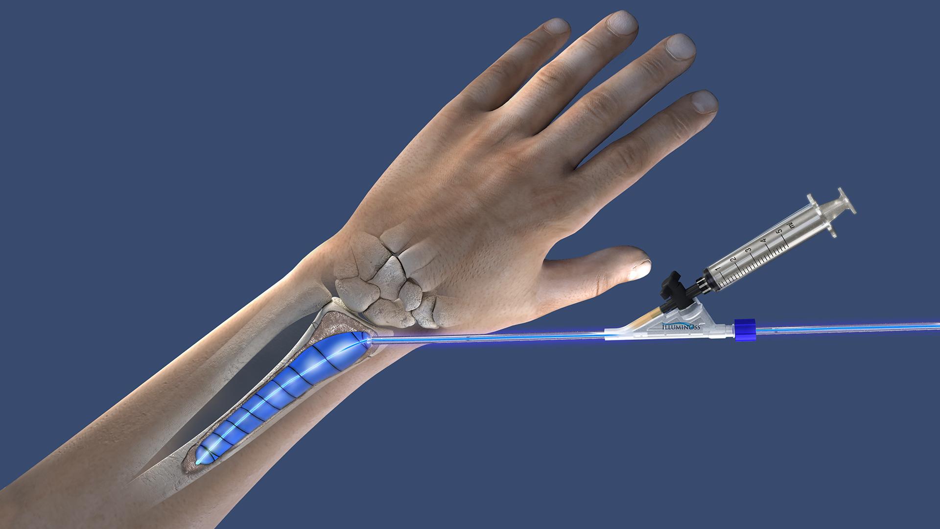 IlluminOss Hand