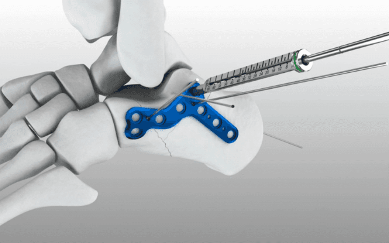 Calcaneal Plate