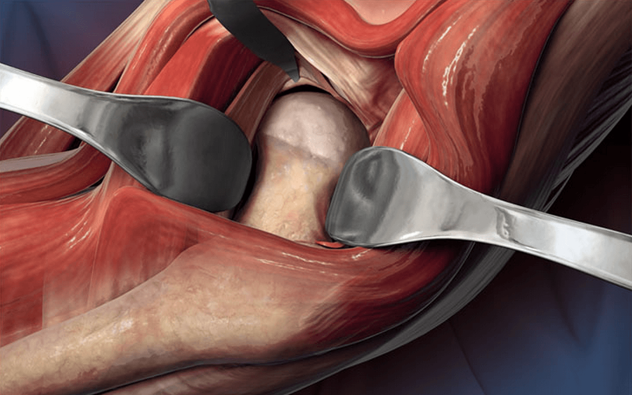 Femoral Ball