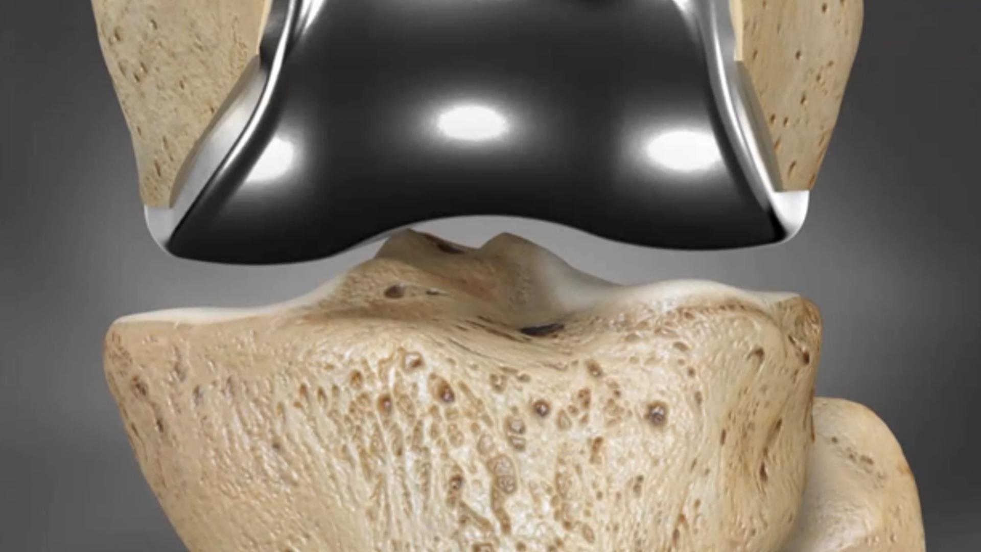 Titanium knee